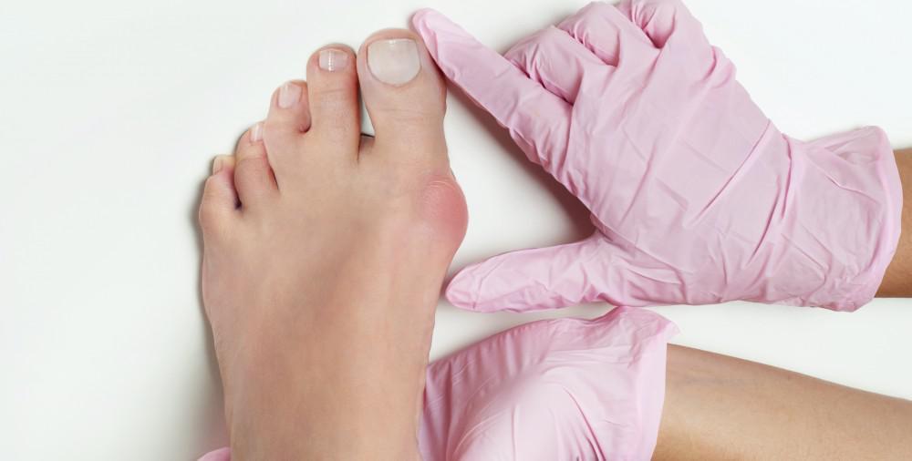 How to Prevent a Bunion 