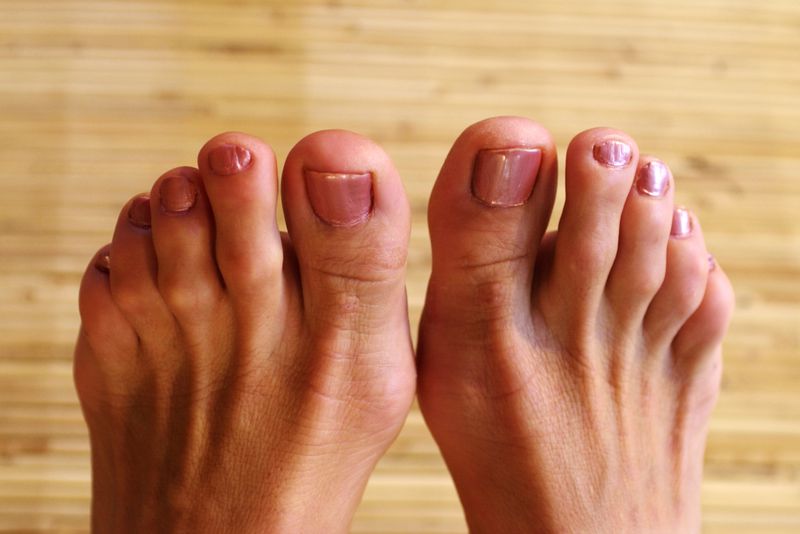 Hammertoes!   How to treat based on type.