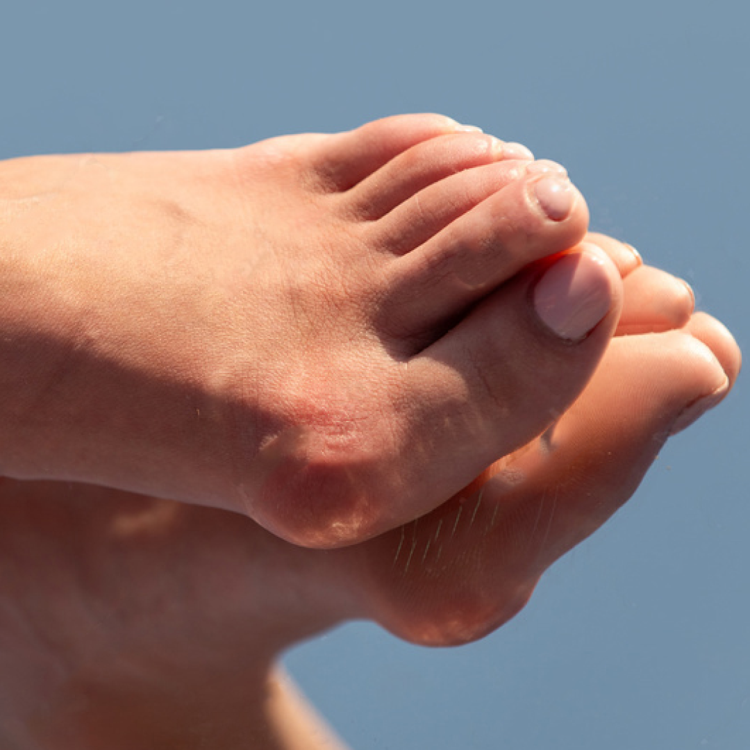 Bunions & Big Toe Mobility | A Solution-Based Approach